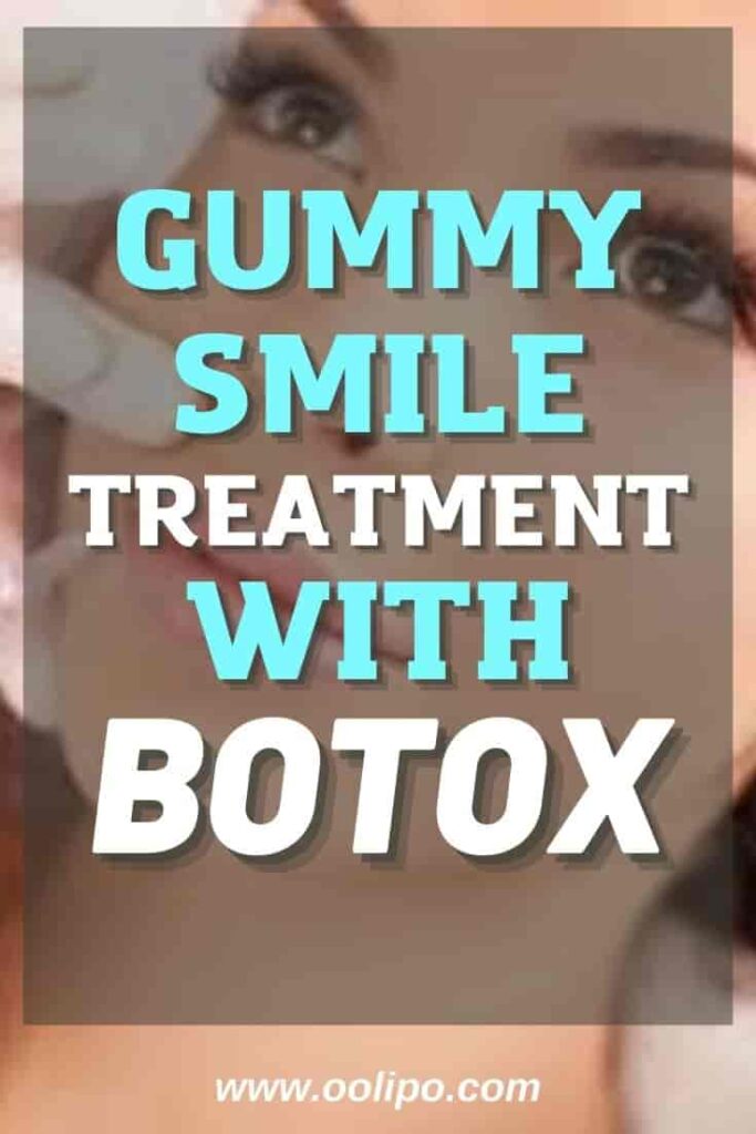 Gummy Smile Treatment with Botox