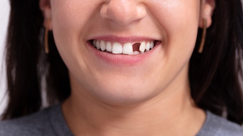 How to Fix Missing Teeth? Dental Tooth Replacement Options Explained